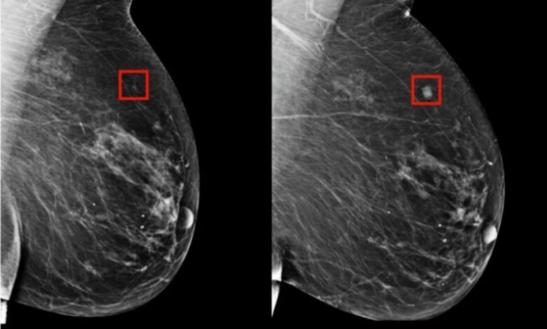 Inteligjenca Artificiale u ndihmon mjekëve të zbulojnë më herët kancerin e gjirit